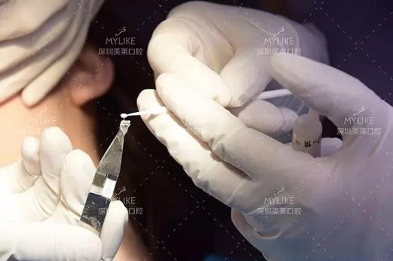 美女矫正牙齿