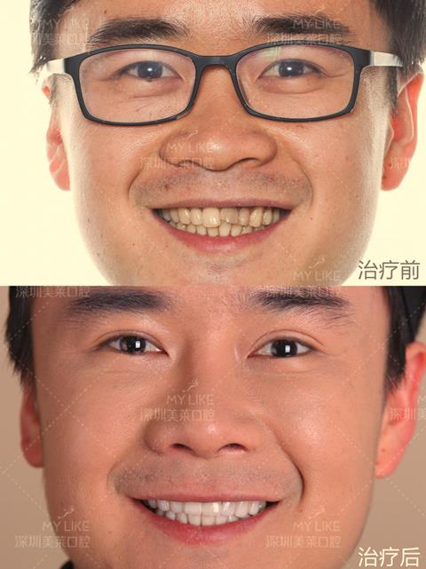帅哥贴面美牙案例